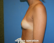 plastic-surgery-breast-augmentation